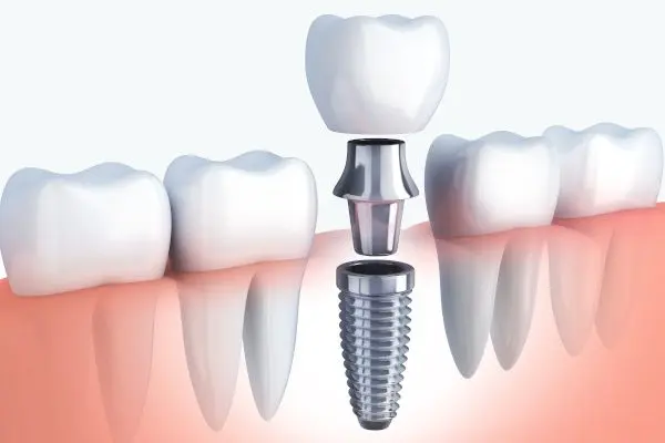 Ankara'da İmplant Tedavisi: Eksik Dişlere Kalıcı ve Doğal Çözüm